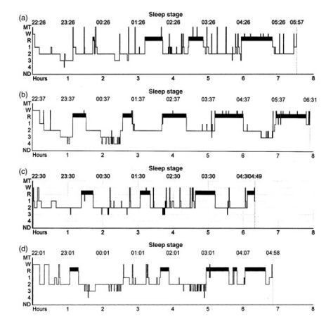 These hypnograms show the sleep architecture of younger (a and b) and older participants (c and d) in both control (a and c) and Vipassana meditation (b and d) groups. Compared to non-meditators, meditators maintain richer patterns of deep (SWS) and REM sleep, even in older age. Notably, NREM Stage 4 is completely absent in the older control participant but preserved in the older meditator—highlighting meditation’s potential to counter age-related decline in restorative sleep.